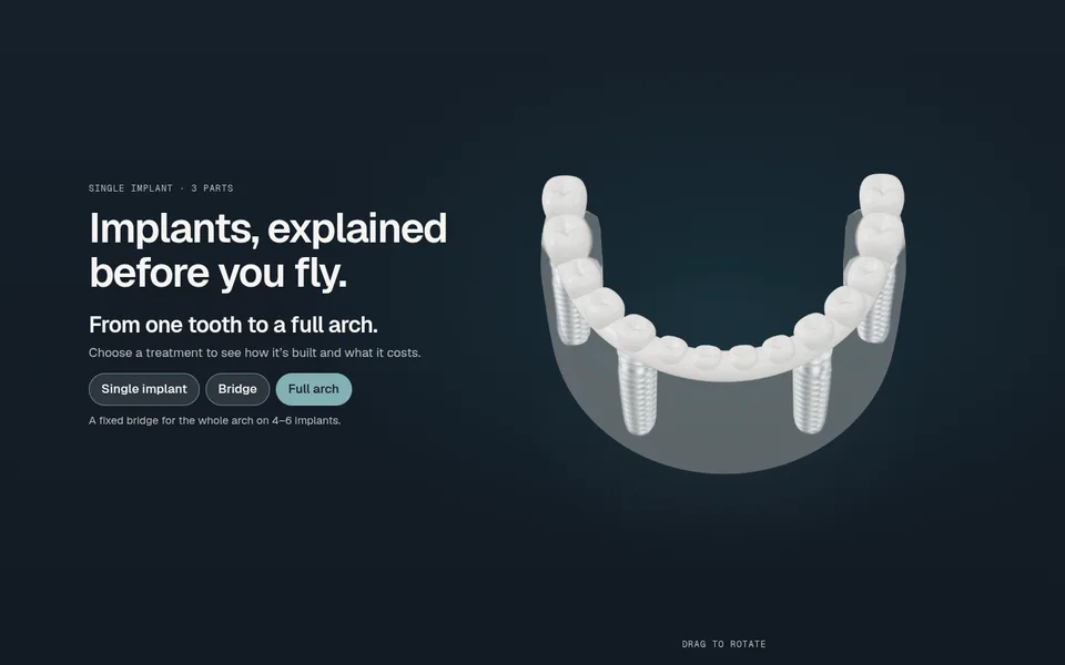 The Full arch option: a zirconia bridge of 14 teeth on four titanium implants.